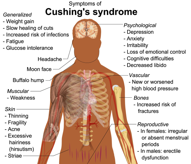 Plakat mit dem Titel "Symptome des Cushing-Syndroms" mit einer schematischen Darstellung des menschlichen Körpers mit markierten Bereichen, die Symptome wie Müdigkeit und Kopfschmerzen anzeigen.